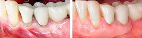 After Periodontal Surgery