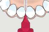 How to use Interdental Brush