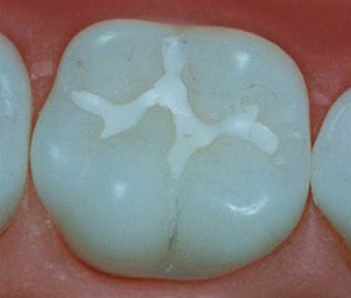 Pit And Fissure Sealants