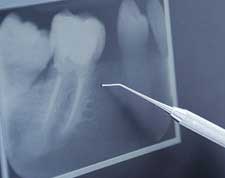 Treatments-root-canal-treatment-small-3
